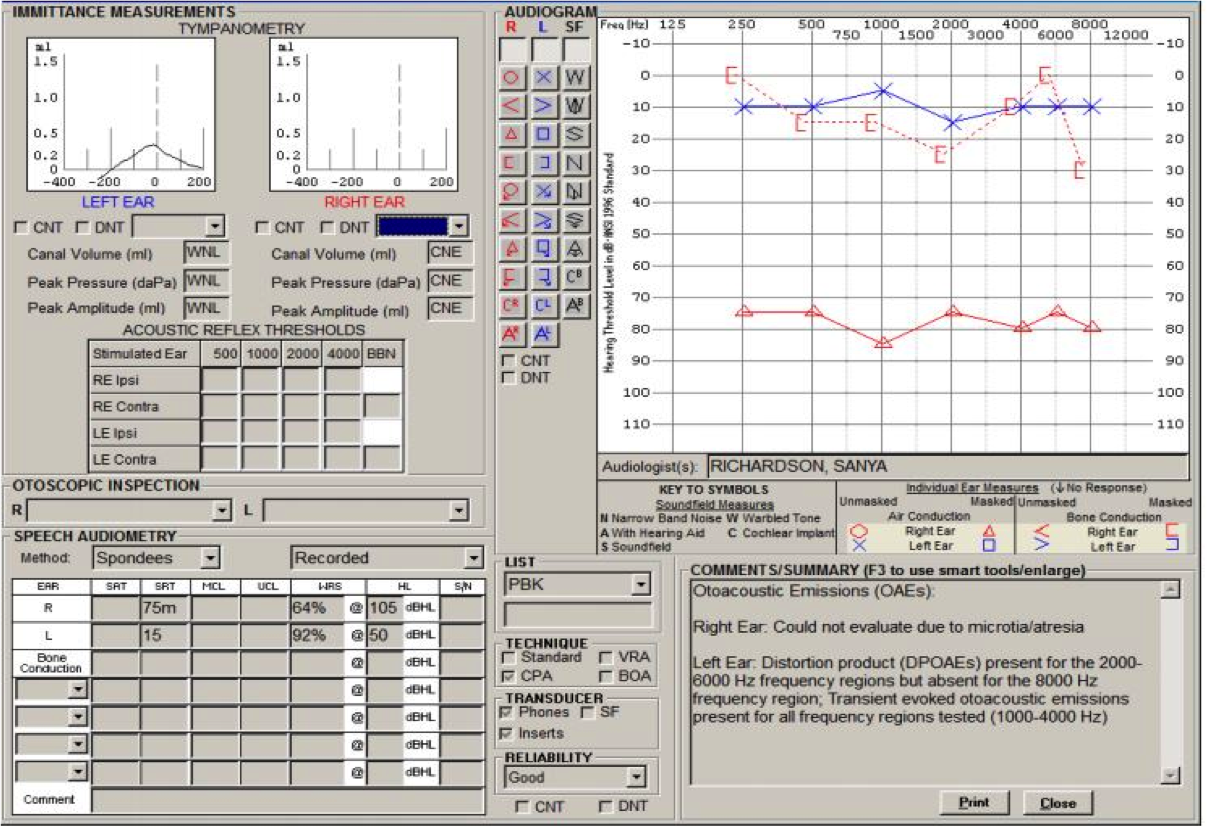 Improvement in hearing with Ponto