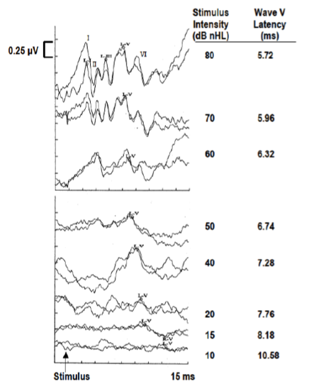 Effects of stimulus intensity on ABR and their changes in morphology