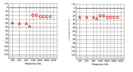 Substandard Acoustic Component thresholds as compared to a good sound field audiogram