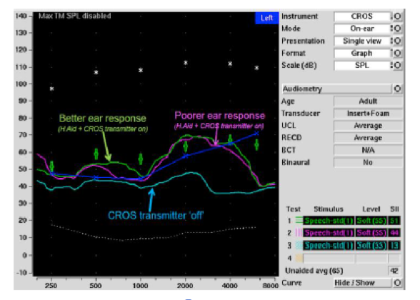 Audiometry graph used to determine if transmitter or CROS system a is faulty