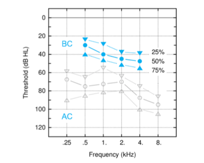Preliminary results of pure tone audiometry