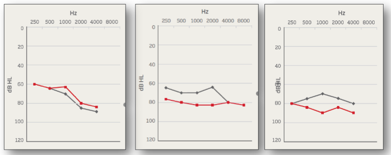 Example audiograms of severe SNHL