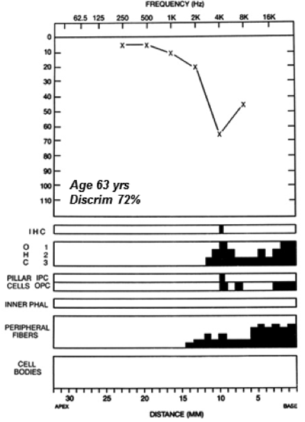 Audiometric thresholds and cochlear histopathology