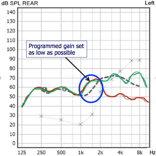 The REOR shows that the gain at 1500 Hz is coming from the signal entering the ear canal due to the open fitting