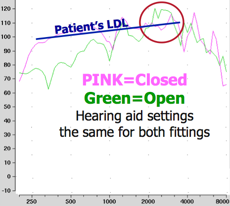 Open fitting versus closed fitting for the same hearing aid using the same programming settings for both conditions