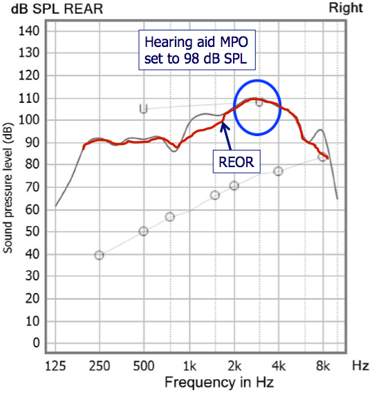 REOR shows that output exceeding LDL is not related to hearing aid fitting, but rather the open fitting and large ear canal resonance