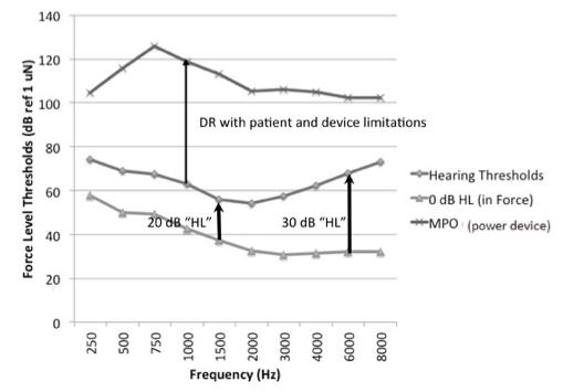 Example showing that dynamic range is reduced because thresholds are elevated due to mixed hearing loss