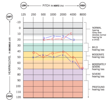 Audiogram for case 1