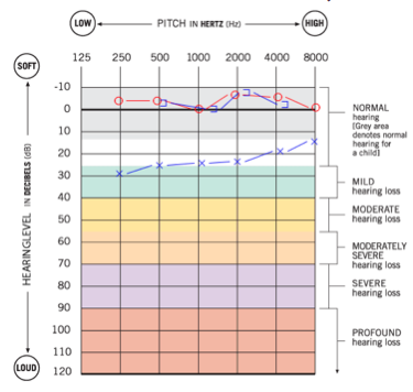 Audiogram for case 2