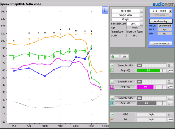 Two different hearing aid fittings for a child with a moderately-severe sloping hearing loss