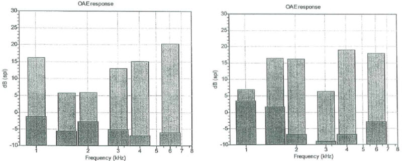 Otoacoustic emissions for case study DL