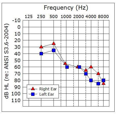 Sample patient’s audiogram with word recognition scores of 68% in the right ear and 44% in the left ear