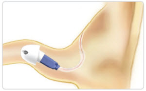 Illustration of the flexibility designed into the easy-CLICK tip to conform to the size, shape and contour of the ear canal bends
