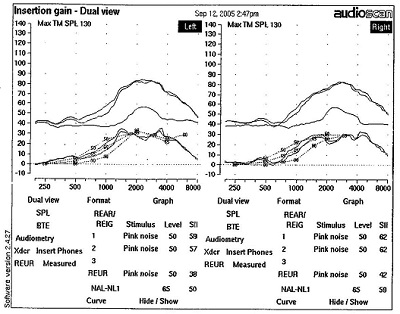 Insertion gain for a steeply sloping hearing loss for soft, moderate and loud inputs