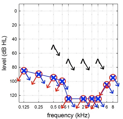 Example of an audiogram from an early-generation cochlear implant candidate