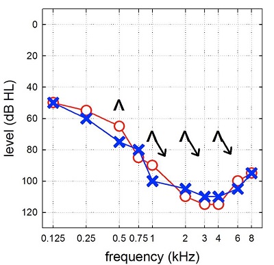 Example of an audiogram from a modern cochlear implant candidate