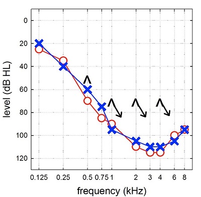 Audiogram demonstrating normal hearing sloping to profound sensorineural hearing loss bilaterally