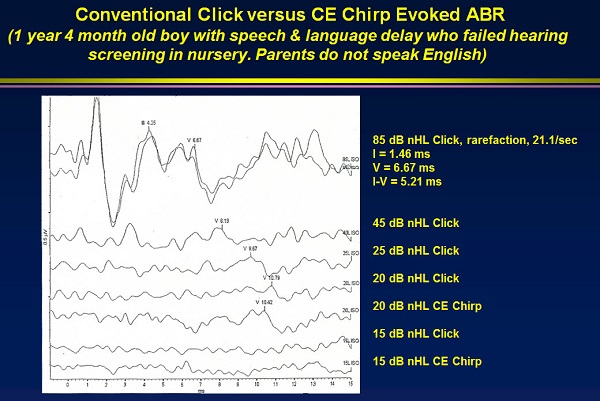 Comparison of a chirp click stimulus compared to a traditional click
