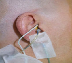 Subdermal needle electrode placement in the ear canal with insert earphone in the ear canal