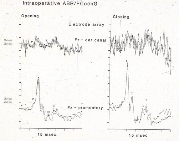 Intraoperative ABR ECochG comparison using tiptrodes versus needle electrodes