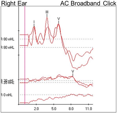 The degree of hearing loss with BERA examination