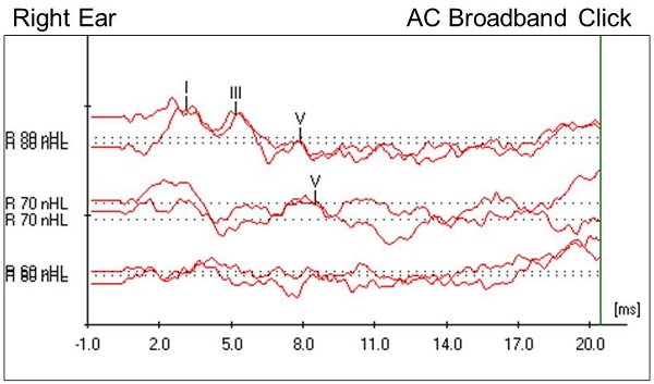 Case #2 right-ear click ABR results