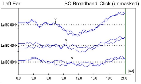 Case #2 left-ear unmasked bone conduction ABR results using a click stimulus