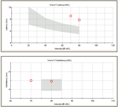Case #2 latency-intensity function top and interwave latency data for the right ear bottom