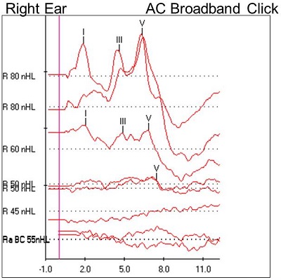 Case #3 right-ear ABR results