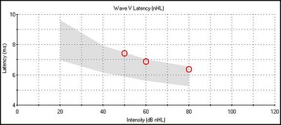 Latency-intensity function for sensory hearing loss