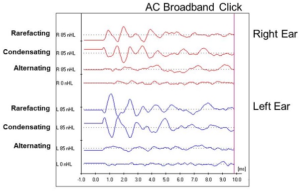 Case #4 waveforms for right and left ear using rarefaction condensation and alternating click stimuli