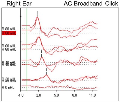 Case #5 right-ear ABR results