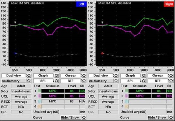 Verification of poorly-fitted flat attenuation earplugs