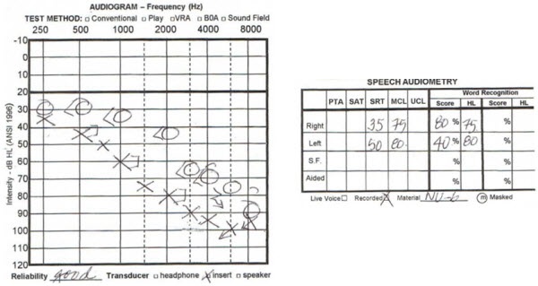 Audiogram from a 75-year old male with asymmetrical hearing loss who felt his right ear was not compromised prior to hearing aid fitting