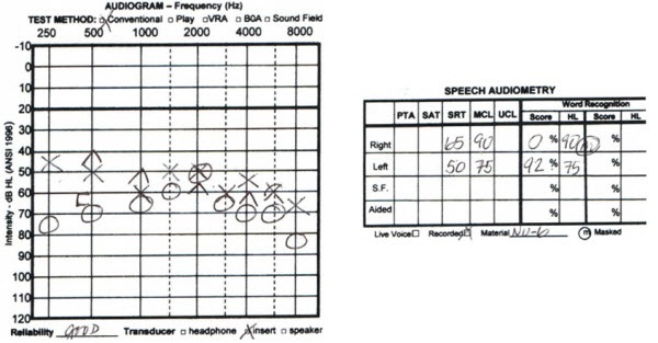 Audiogram from a 68-year-old male with asymmetrical hearing loss and word recognition scores