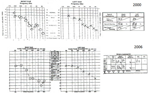 Data from a 71-year-old female patient who was fit bilaterally