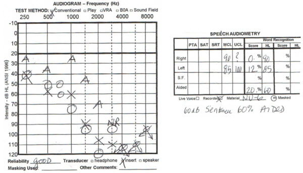 BR at 83 years of age with progression in hearing loss and decrease in word recognition scores bilaterally