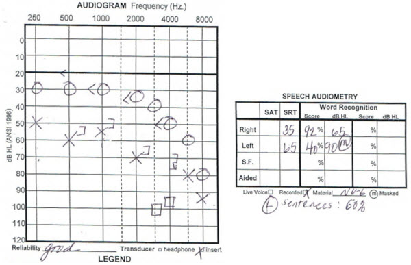 Audiogram from a 75-year-old female with asymmetrical hearing loss and word recognition scores