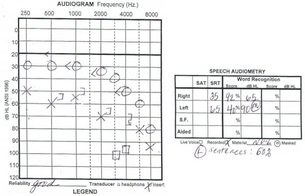 Asymmetrical Sensorineural Hearing Loss Fitting Strategies Donald J Schum Hearing Aids Adults 12222