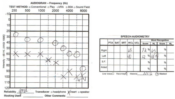 Audiogram from the same patient recorded four years later showing a decrease in word recognition scores