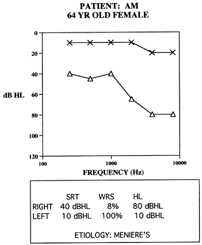 Asymmetrical hearing loss due to Meniere’s disease in a 64-year old patient