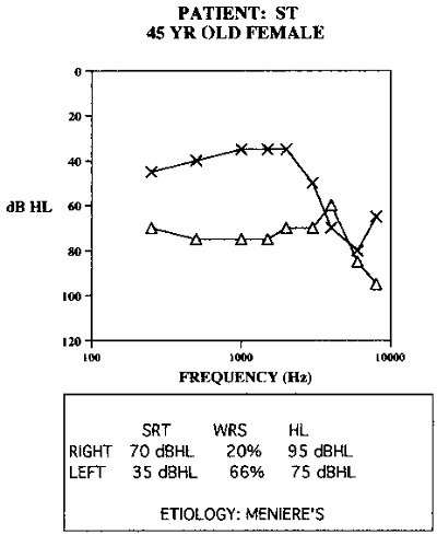 Asymmetrical hearing loss due to bilateral Meniere’s disease in a 45-year old patient