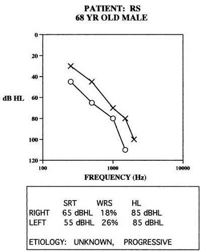 Asymmetrical progressive hearing loss in a 68-year old patient