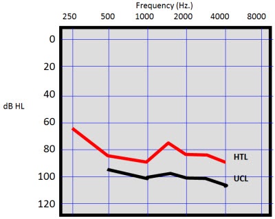 Patient with dead ear on the left side and severe hearing loss in the right ear due to Meniere’s disease