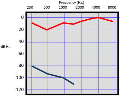 Patient with severe sudden sensorineural hearing loss in the left ear