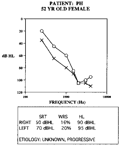 Asymmetrical hearing loss with poor word recognition. Hearing aid fitting on the poorer ear did not improve word recognition but increased distortion