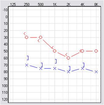 Asymmetrical hearing loss due to Meniere’s disease. the right ear was fit prior to the left ear