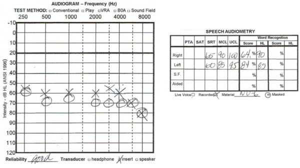 Audiogram from a 52-year-old female with congenital hearing loss who perceived her right ear to be much worse than the left