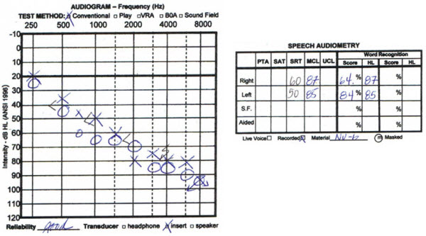 Audiogram from an 86-year-old male with symmetrical hearing loss but perceived functional imbalance between ears