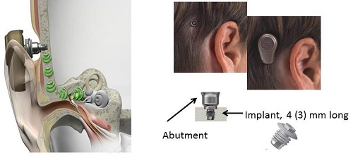 Bone anchored hearing system, where sound is transmitted by bone conduction via the skull to the bony cochlea